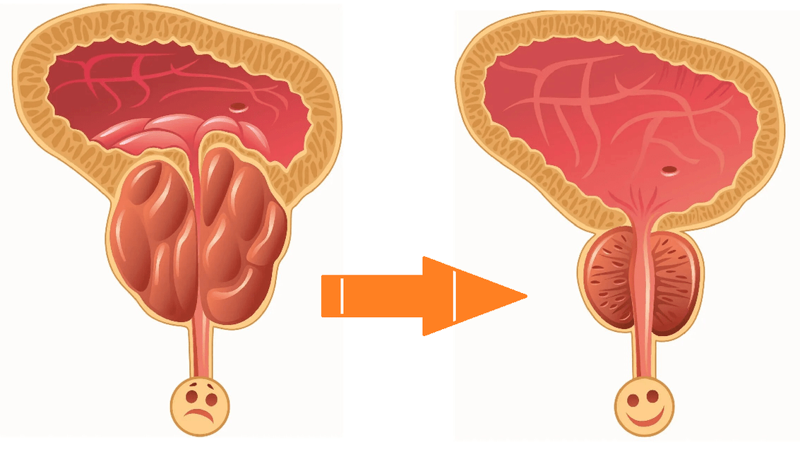 Učinak Uromexil Forte-a na prostatu s prostatitisom i adenomom